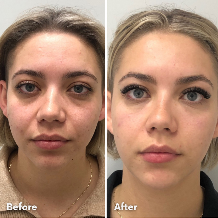 DermaVision™ Under-Eye Red Light Therapy